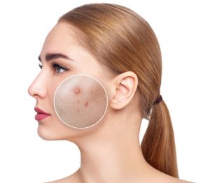 فوم ژل شستشو اوی سبودرم
