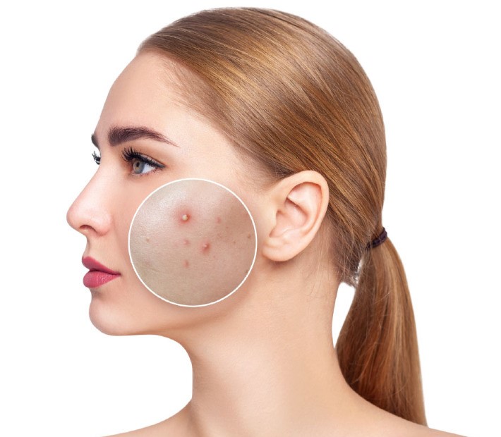 فوم ژل شستشو اوی سبودرم